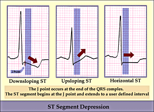 Panel A shows a normal ST-segment, which is flat compared to the PR